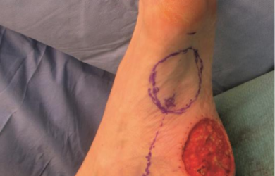 Образовательный центр WETLAB | Виды лоскутов на питающих ножках и область их применения