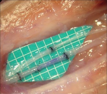 Виды микрососудистых анастмозов и правила их наложения