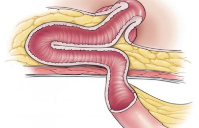 Фото из: Atlas of Intestinal Stomas. Автор: Victor W. Fazio. Образовательный центр WETLAB | Фото из: Atlas of Intestinal Stomas. Автор: Victor W. Fazio.