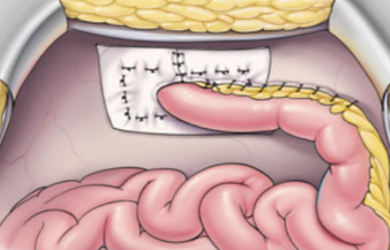 Фото из: Atlas of Intestinal Stomas. Автор: Victor W. Fazio. Образовательный центр WETLAB | Фото из: Atlas of Intestinal Stomas. Автор: Victor W. Fazio.
