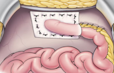 Фото из: Atlas of Intestinal Stomas. Автор: Victor W. Fazio. Образовательный центр WETLAB | Фото из: Atlas of Intestinal Stomas. Автор: Victor W. Fazio.