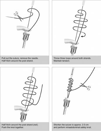 Способы формирования узла и петли Рёдера в эндовидеохирургии