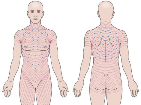 Образовательный центр WETLAB | Линии Лангера и их влияние на выбор оперативного доступа