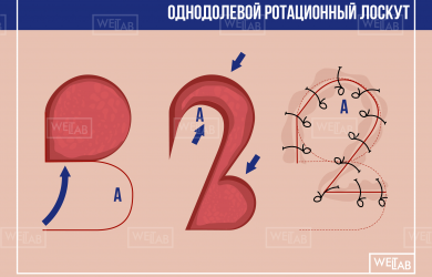 Образовательный центр WETLAB | Основы пластической хирургии. Лоскутные способы закрытия раневых дефектов.