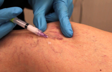 Modern methods of treatment of varicose veins. Образовательный центр WETLAB | Modern methods of treatment of varicose veins.