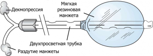 Декомпрессия кишечника при помощи зонда Миллера - Эббота