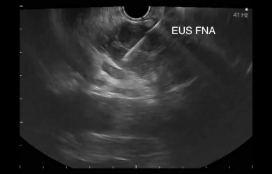 Endosonographic image using a convection sensor at the time of puncture Образовательный центр WETLAB | Endosonographic image using a convection sensor at the time of puncture