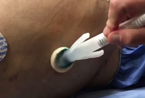 Laparocenesis. Operation technique.