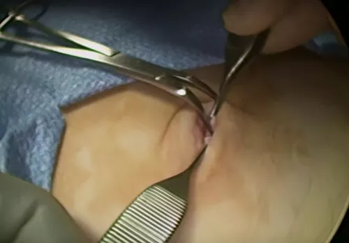 Laparoscopic appendectomy. Technique of execution.