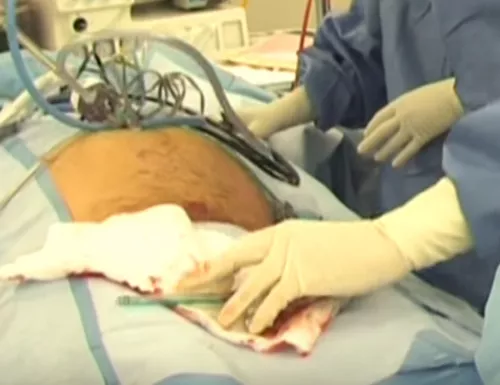 Laparoscopic appendectomy. Technique of execution.