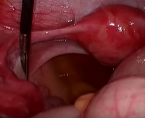 Laparoscopic appendectomy. Technique of execution.