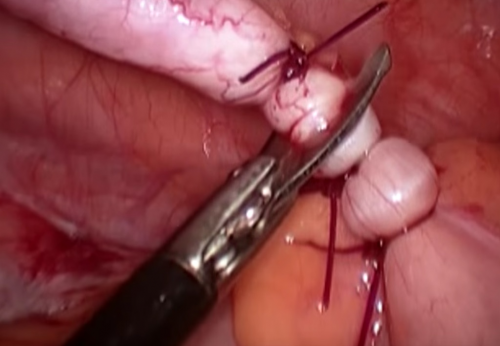 Laparoscopic appendectomy. Technique of execution.