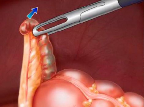 Образовательный центр WETLAB | Laparoscopic appendectomy. Technique of execution.
