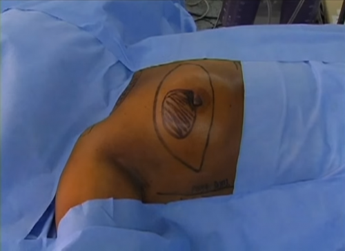 Modified Radical Mastectomy