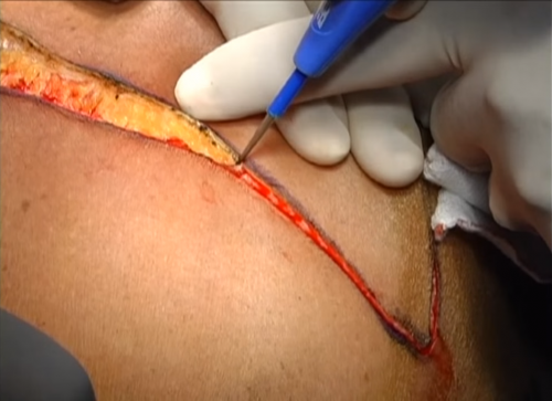Modified Radical Mastectomy
