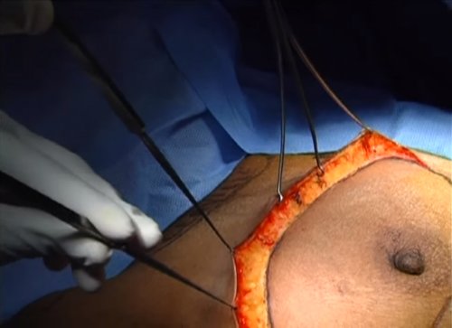 Modified Radical Mastectomy