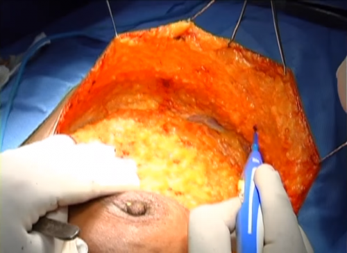 Modified Radical Mastectomy