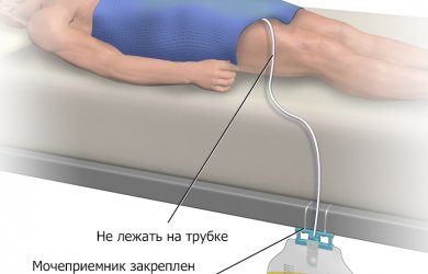 После катетера больно. Моче приёмник к катетер Фолея. Дренажная система мочевого пузыря. Катетер для лежачих мужской.