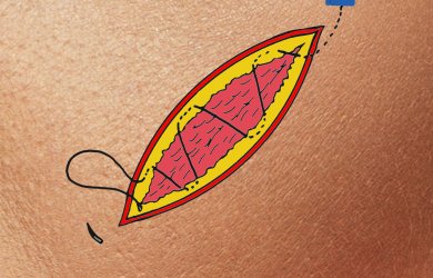 Образовательный центр WETLAB | Хирургические узлы и швы - особенности применения